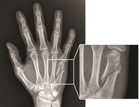 metacarpal fracture long finger